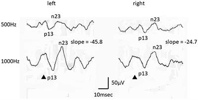 Simultaneous Presentation of Definite Vestibular Migraine and Definite Ménière's Disease: Overlapping Syndrome of Two Diseases